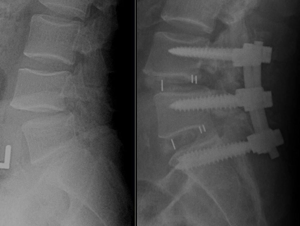 Keyhole Spinal Fusion Surgery