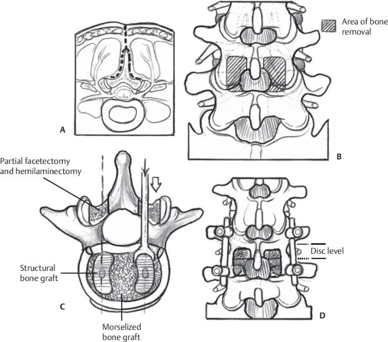 Keyhole Spinal Fusion Surgery - Centre for Orthopaedics