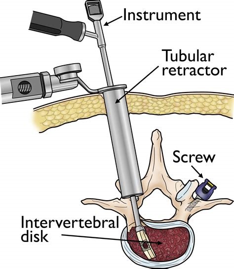 Keyhole Spine Surgery