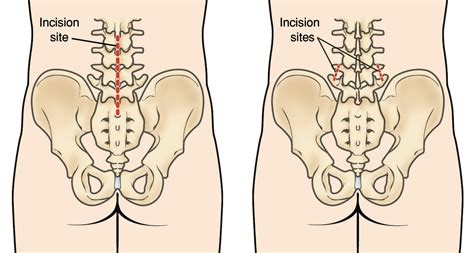 Keyhole Spine Surgery