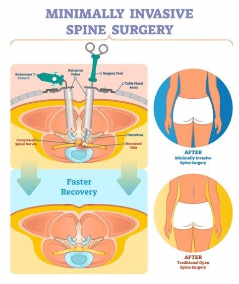 Keyhole Spinal Fusion Surgery