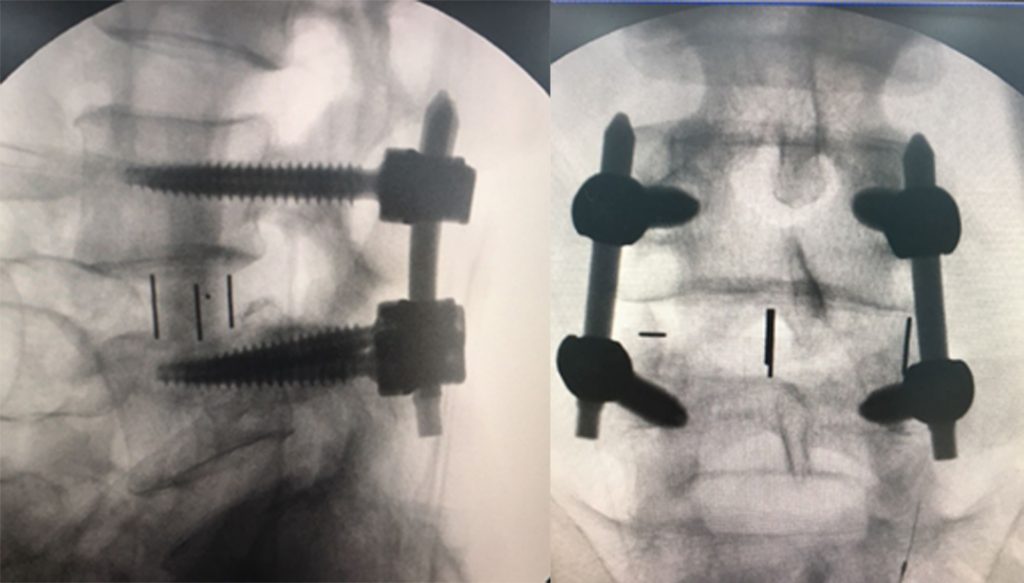 Spine Surgery