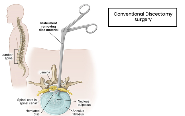 Conventional-Discectomy-surgery