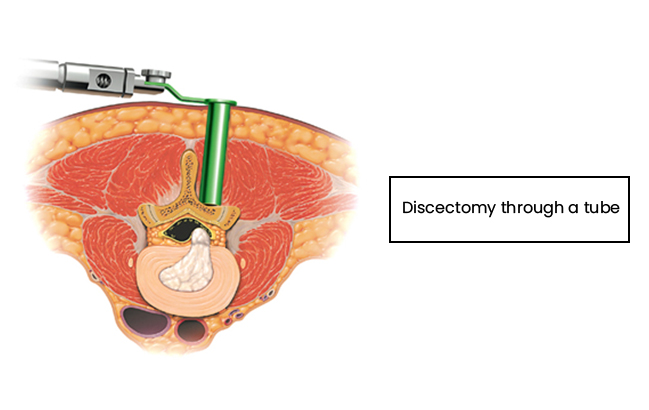 Slipped Disc - Discectomy-through-a-tube