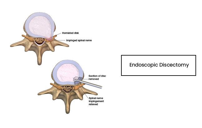 Endoscopic-Discectomy